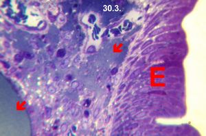 Whipple diseaselipid ,alabsorption - arrows(semithin section)